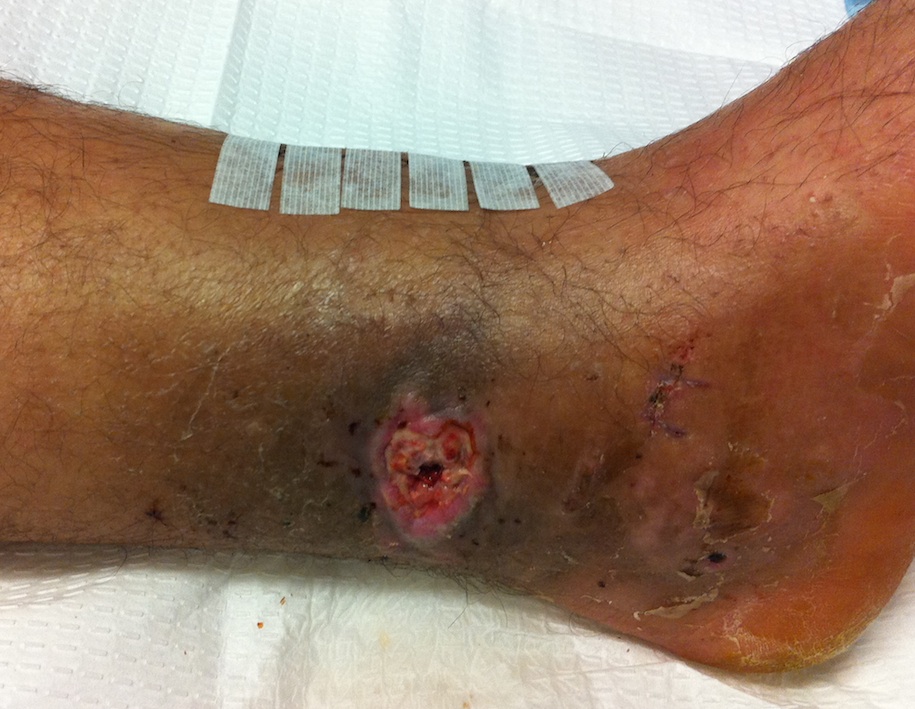 Tibial Plafond Wound Breakdown